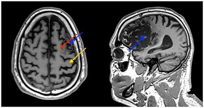 Functional MRI evaluation of hyperbaric oxygen therapy effect on hand motor recovery in a chronic post-stroke patient: a case report and physiological discussion